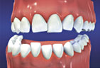 Orthodontic treatment is effective for crooked teeth and jaw out of alignment problems Crooked Teeth and Jaw out of alignment
