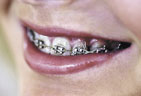 Brackets are needed for most orthodontic treatments Orthodontic brackets bonded