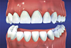 Once your treatment is complete you will have straight and beautiful teeth Straight and Beautiful Teeth