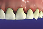 The early stage of periodontics are bleeding gum called Gingivitis Gingivitis