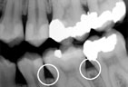 Bacteria moves into the pockets where it will continue to promote irriations Periodontitis