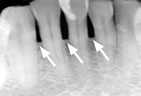 Left untreated thes can continue down into the bone and other tooth supporting tissues Advanced Periodontitis